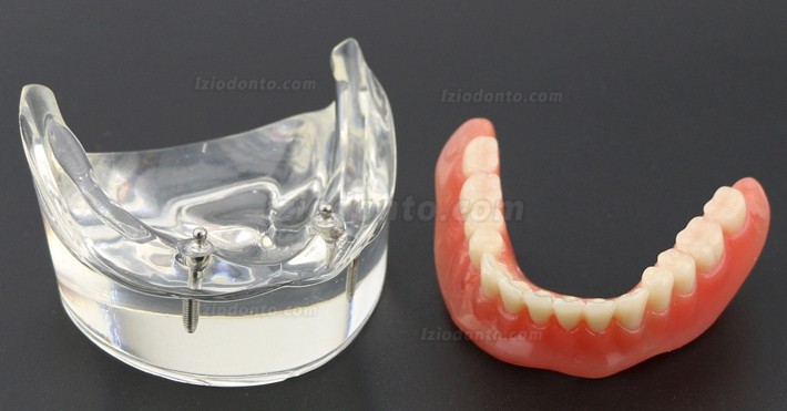 Dentes dentais modelo sobredentadura inferior com 2 implantes 6002 01